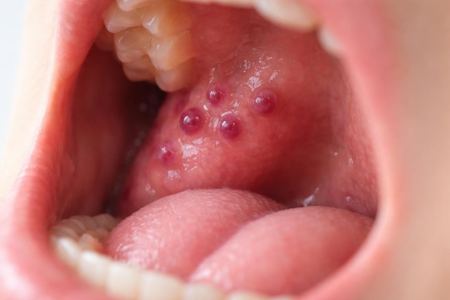 découvrez ce que sont les boules de sang dans la bouche, leurs causes possibles, et les implications pour votre santé bucco-dentaire.