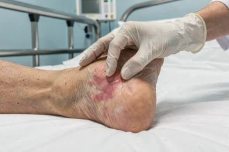 Infirmière examinant une rougeur cutanée sur le talon d'une personne âgée hospitalisée, premier stade d'escarre